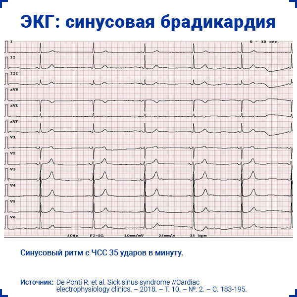 ЭКГ синусовая брадикардия